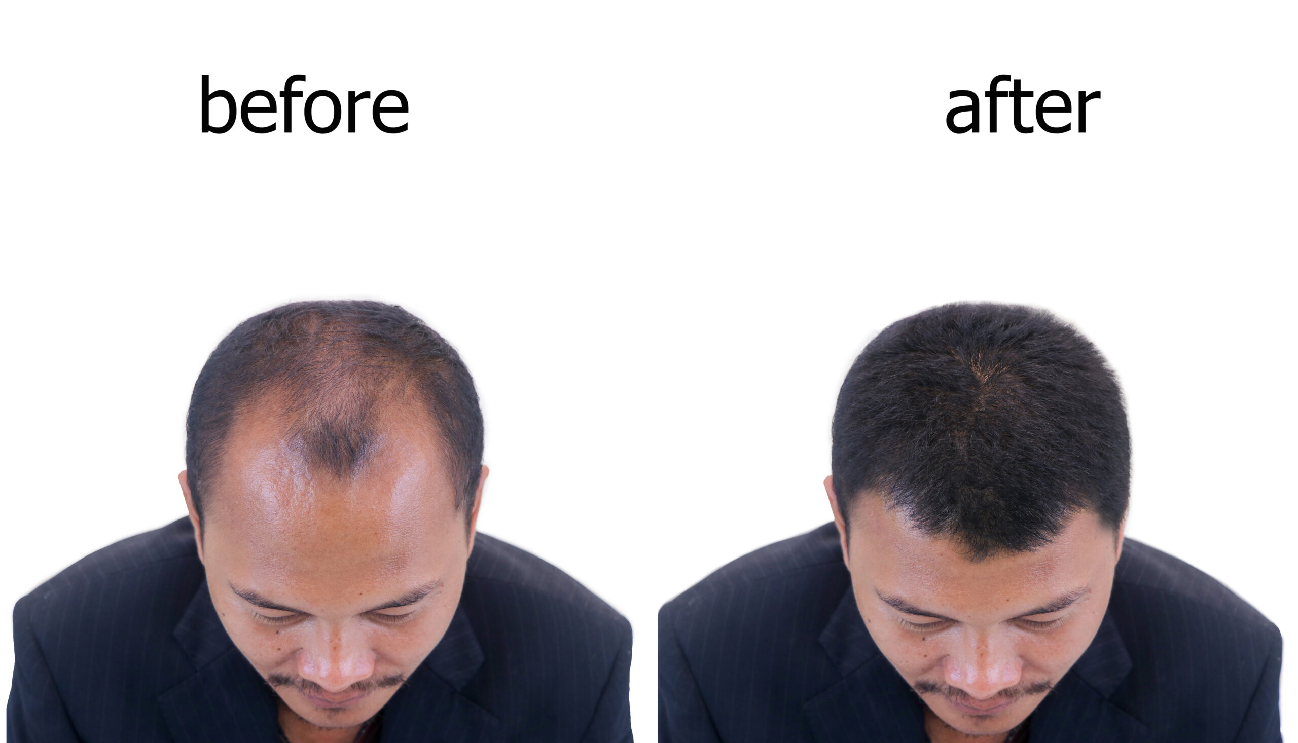 Before and After Hair Transplant Montreal