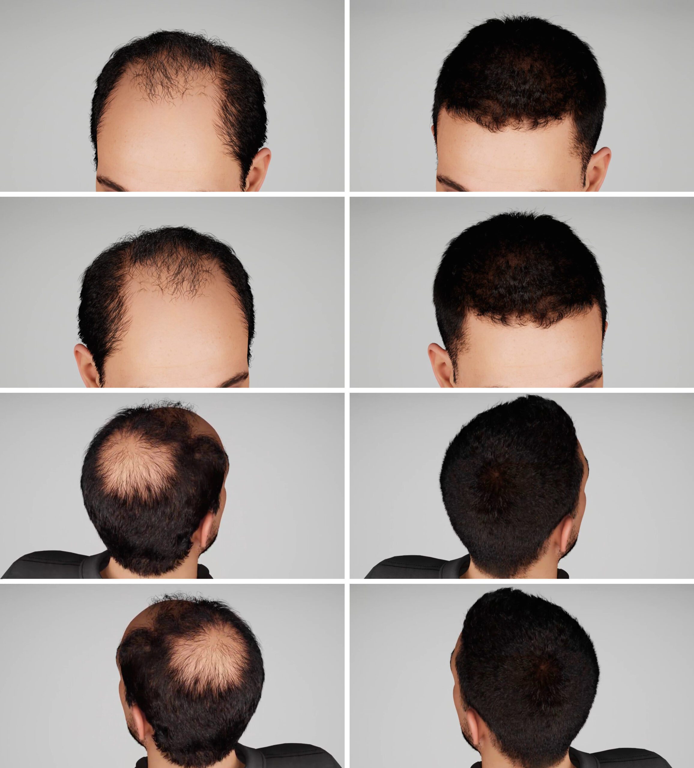 Hair transplant clinic montreal